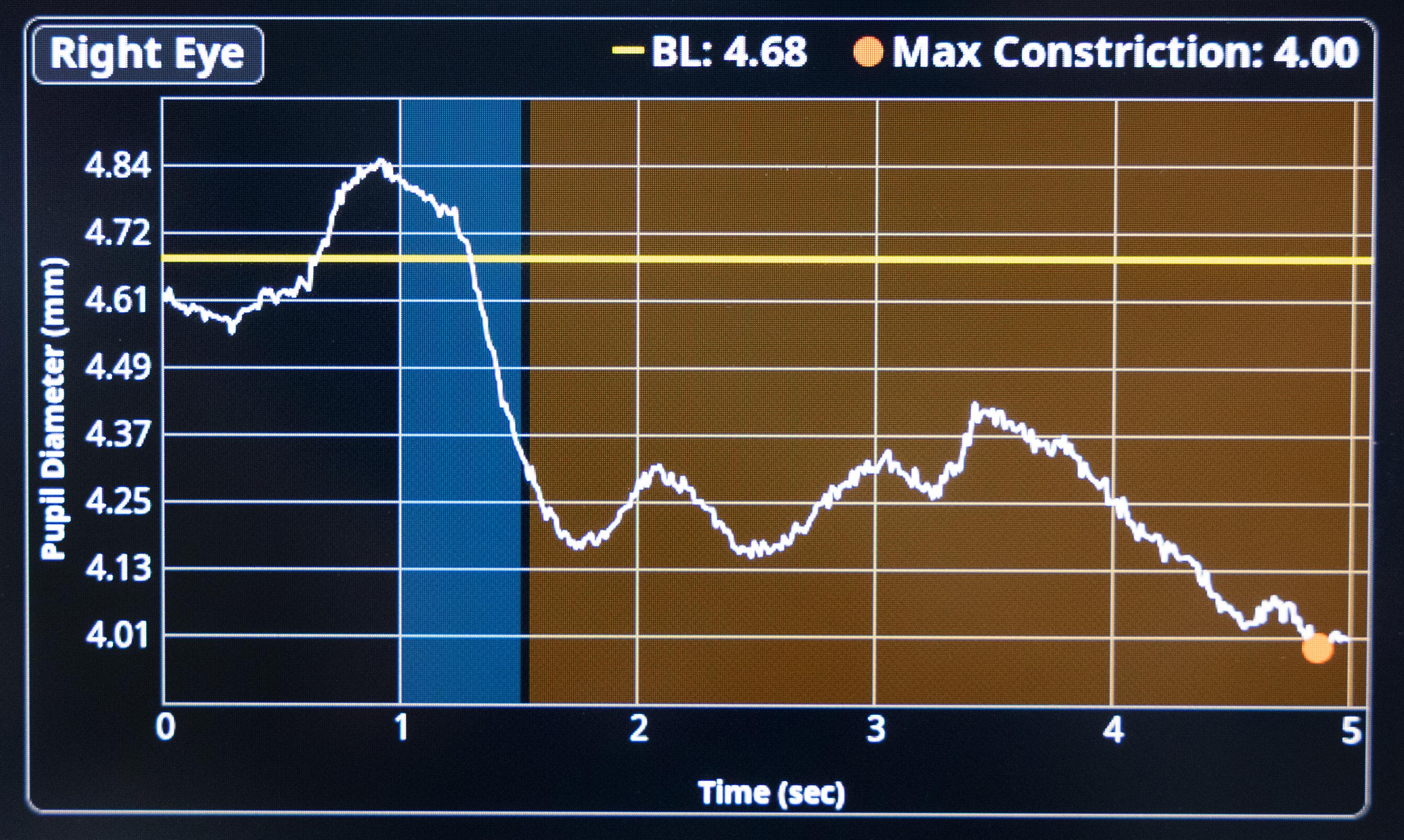 Screen displaying pupillary light reflex measurement data.