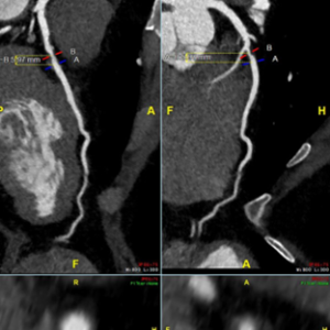 cardiac ct scan image