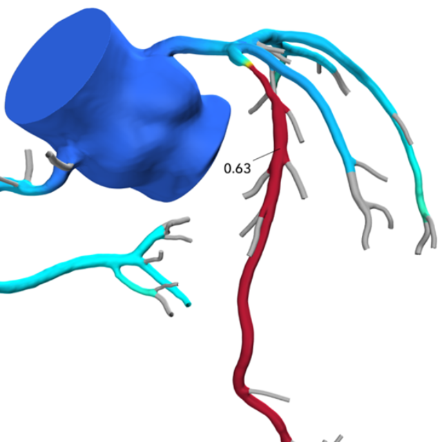 Graphic of arteries around the heart