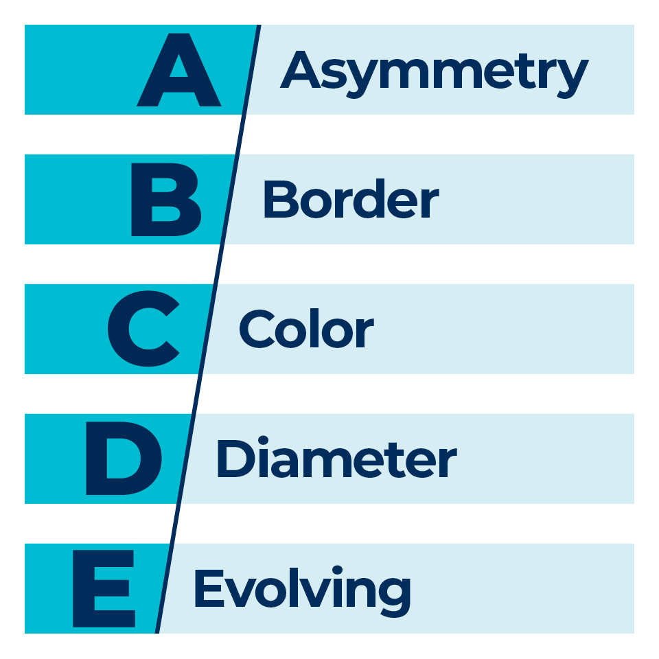 ABCDE stands for: Asymmetry, Border, Color, Diameter, Evolving