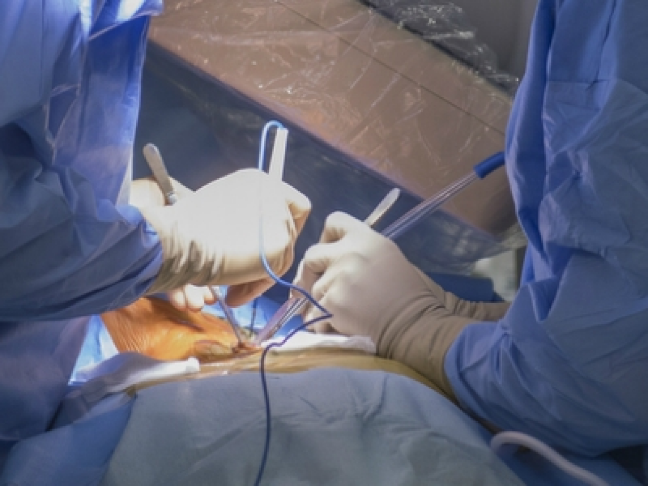 Surgeons working on a general surgery patient