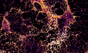 A microscopic view of a slow-growing breast cancer tumour that has shrunk in response to standard hormone therapy and a new experimental Rac1 inhibitor.