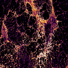 A microscopic view of a slow-growing breast cancer tumour that has shrunk in response to standard hormone therapy and a new experimental Rac1 inhibitor.