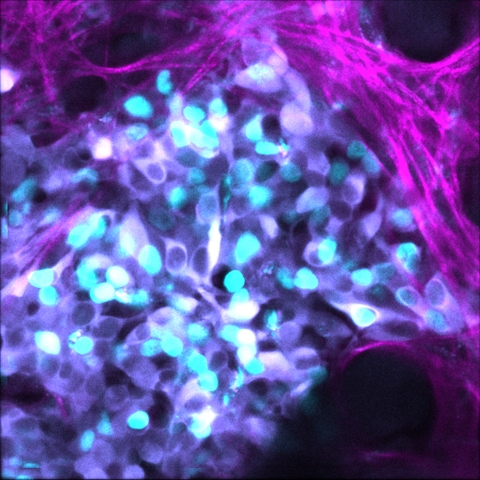 Imaging showing neuroblastoma cells (cyan) growing as a tumour and the surrounding collagen matrix (magenta).