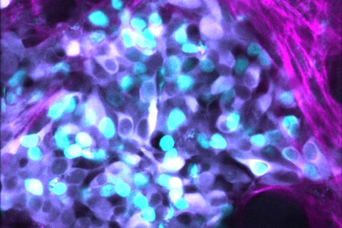 Imaging showing neuroblastoma cells (cyan) growing as a tumour and the surrounding collagen matrix (magenta). Credit: Dr Max Nobis