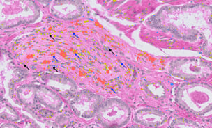 The newly discovered cell type (yellow) shown clustering around a prostate cancer nerve bundle.