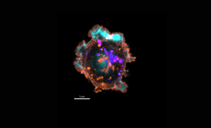 A microscopic close-up of a natural killer (NK) immune cell. In a healthy immune system, toxic granules (seen here in magenta) are deployed to destroy infected cells. In patients with MKD, these granules remain trapped inside the cell.
Credit: Dr James Cremasco