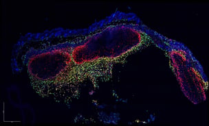 A highly magnified view of melanoma tumours growing in the skin. CD169+ macrophages are shown in green and yellow forming a biological boundary wall to contain the tumours.
