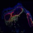 A highly magnified view of melanoma tumours growing in the skin. CD169+ macrophages are shown in green and yellow forming a biological boundary wall to contain the tumours.
