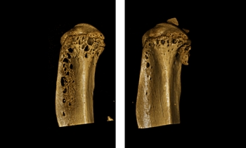 Bone deteriorated by multiple myeloma is regenerated after treatment with romosozumab (right) in a mouse model.