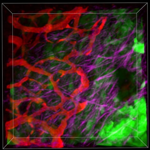 Microscopic view inside mouse model of pancreatic cancer tumour. The ...
