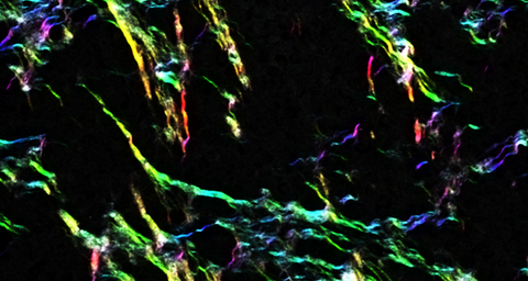 Collagen fibres running through a cancer tumour, created using a multiphoton microscope.