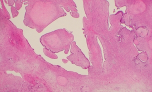 A phyllodes tumour's characteristic leaf-like cellular structure is not enough to identify it as malignant or benign, as in this borderline case.