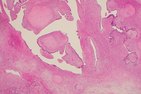 A phyllodes tumour's characteristic leaf-like cellular structure is not enough to identify it as malignant or benign, as in this borderline case.
