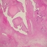 A phyllodes tumour's characteristic leaf-like cellular structure is not enough to identify it as malignant or benign, as in this borderline case.
