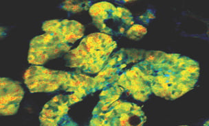 Breast cancer cells in a preclinical model glow blue/green when CDK1 – the ‘engine’ of cell division – is switched on. Credit: Dr Max Nobis