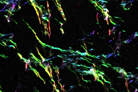 Collagen Powder Cancer Collagen a key player in breast cancer metastasis | Garvan Institute of ...