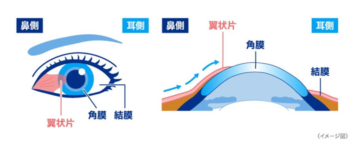 翼状片 角膜 結膜 イメージ図