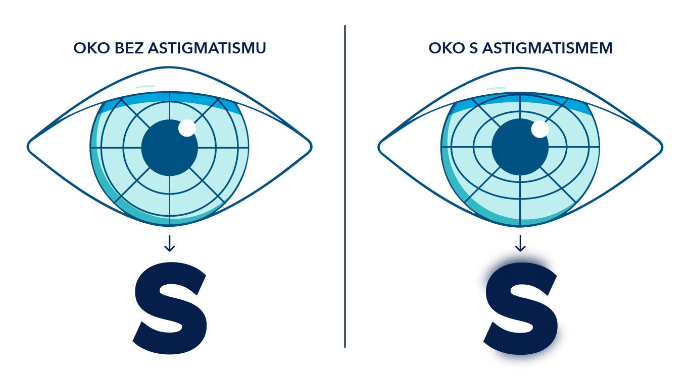Ilustrované oko vlevo zobrazuje ostré písmeno S, zatímco oko s astigmatismem vpravo zobrazuje rozostřené písmeno S.