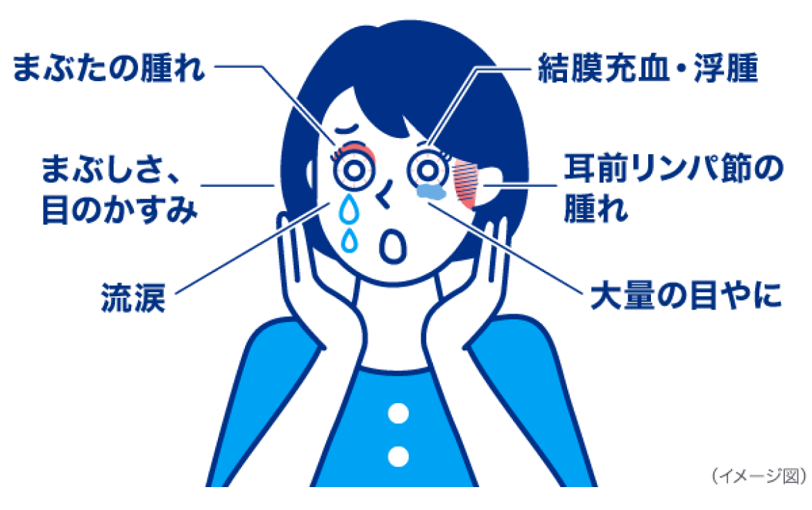 まぶたの腫れ　結膜充血・浮腫　まぶしさ、目のかすみ　流涙　耳前リンパ節の腫れ　大量の目やに　イメージ図