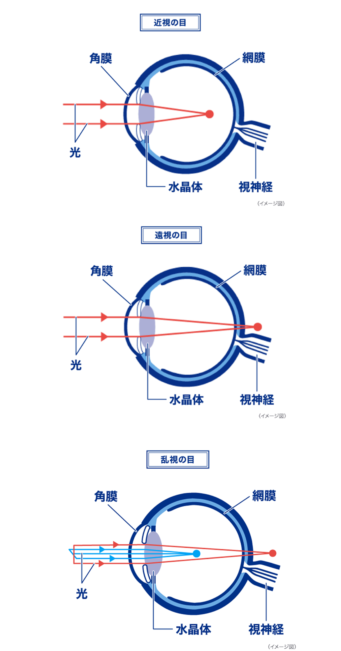（イメージ図）近視の目、遠視の目、乱視の目