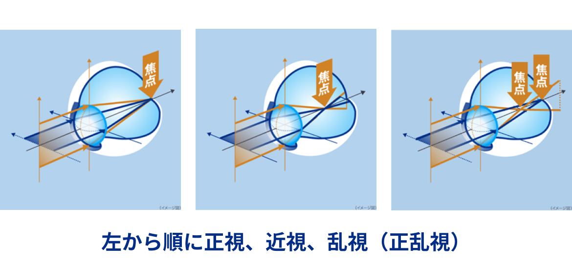 左から順に正視、近視、乱視（正乱視）