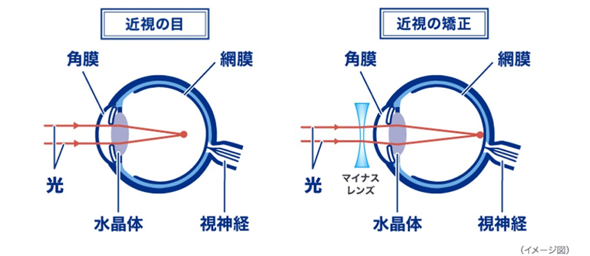 イメージ図:近視の目、近視の矯正 イメージ図:近視の目、近視の矯正