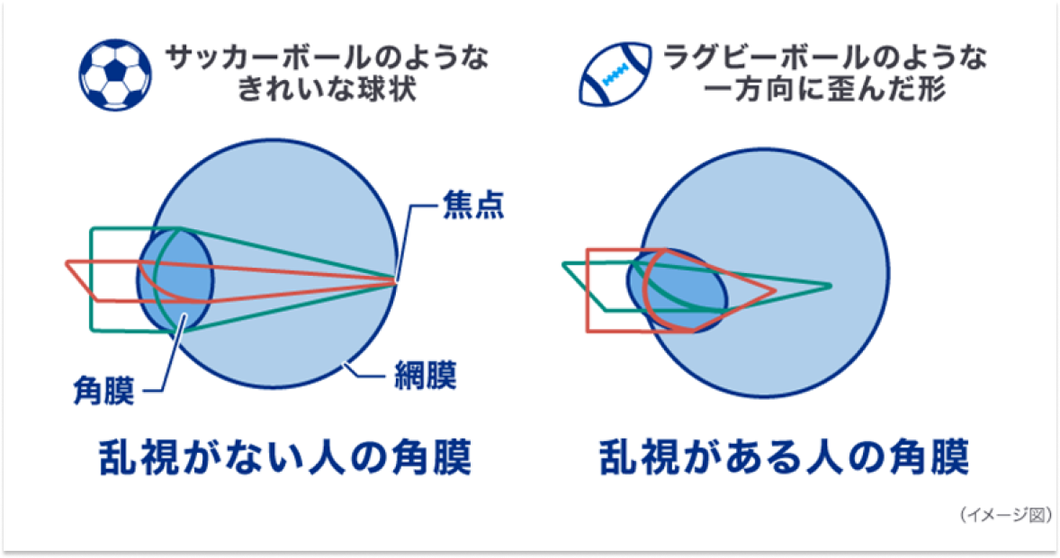 乱視がない人の角膜 乱視がある人の角膜