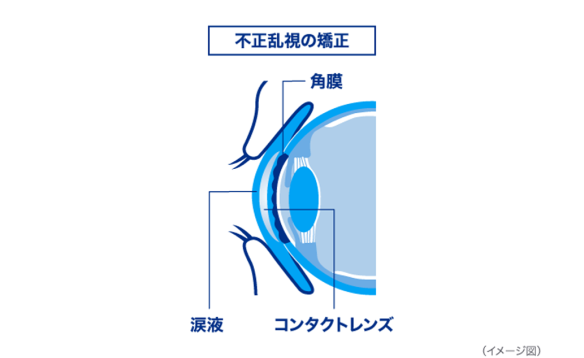 不正乱視の矯正