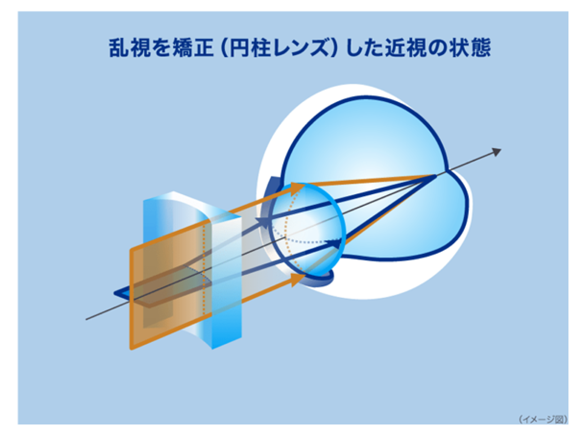 乱視を矯正（円柱レンズ）した場合の状態