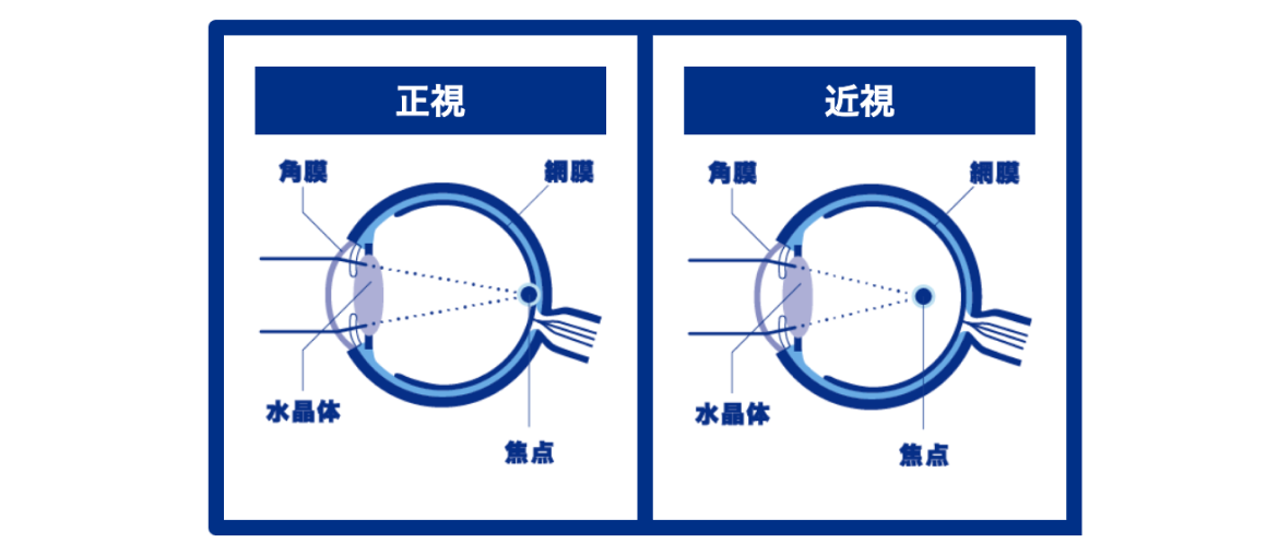 正視　近視