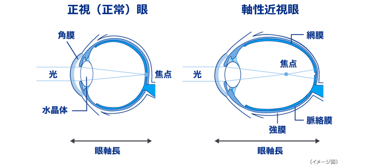 正視（正常）眼　軸性近視眼