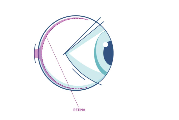 An illustration showing where the retina is in the eye.