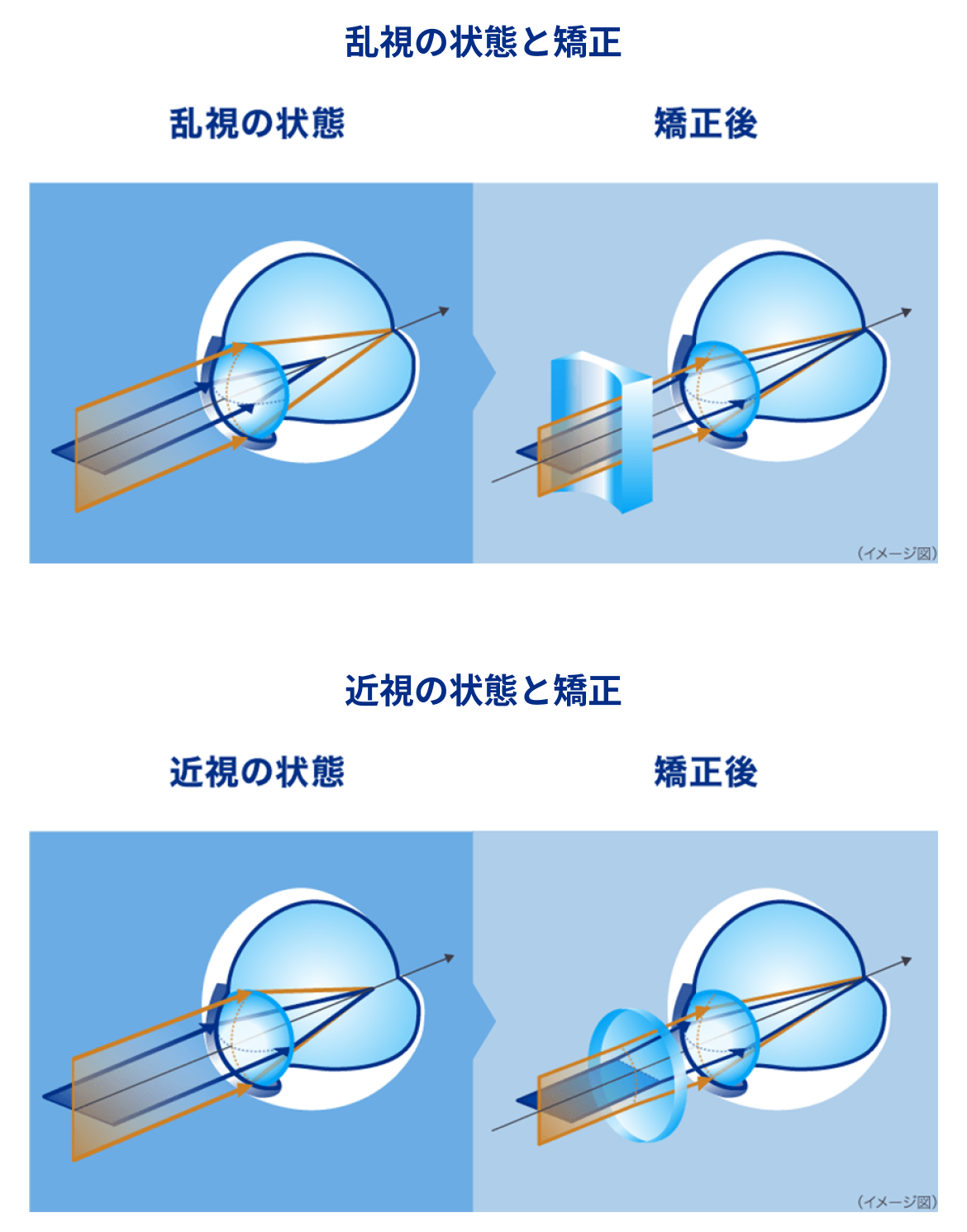 乱視の状態と矯正 近視の状態と矯正