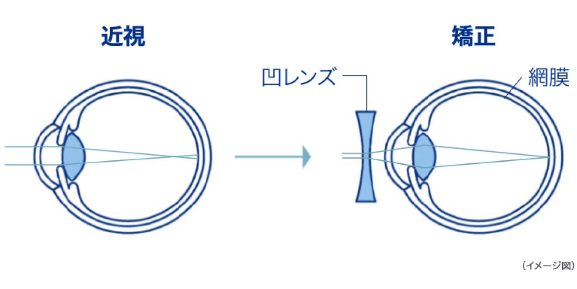 近視　矯正　凸レンズ　網膜　イメージ図