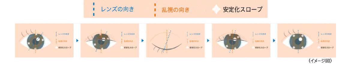 厚みのある部分が上下のまぶたから押されレンズの回転を制御し、乱視の向きとレンズの向きを合わせます。 厚みのある部分が上下のまぶたから押されレンズの回転を制御し、乱視の向きとレンズの向きを合わせます。
