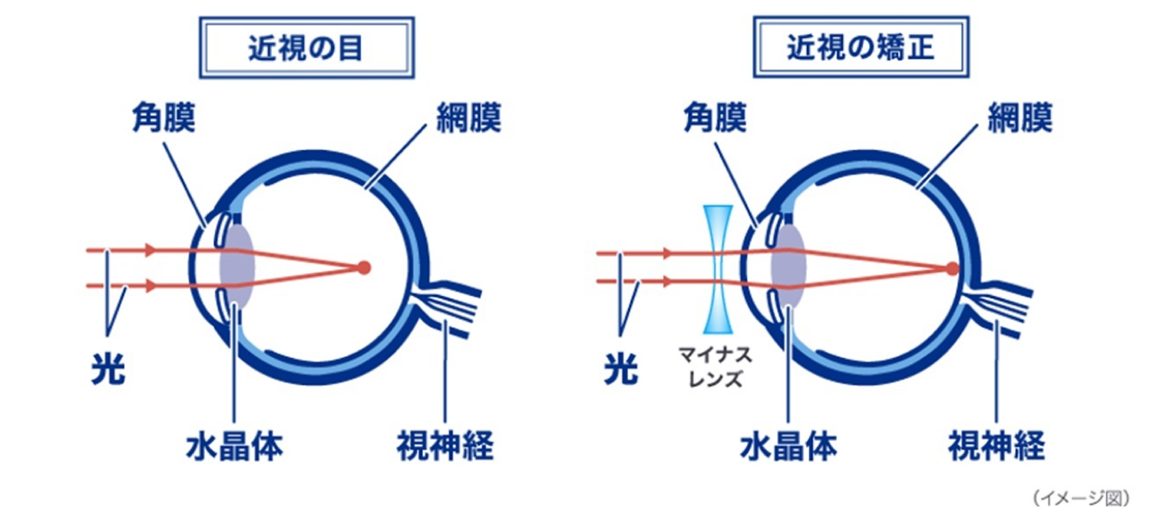 近視の目 近視の矯正