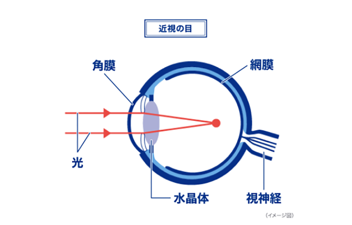 近視の目