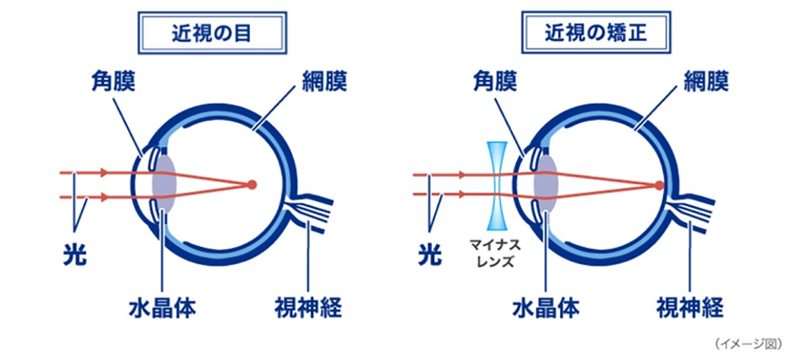 イメージ図：近視の目、近視の矯正