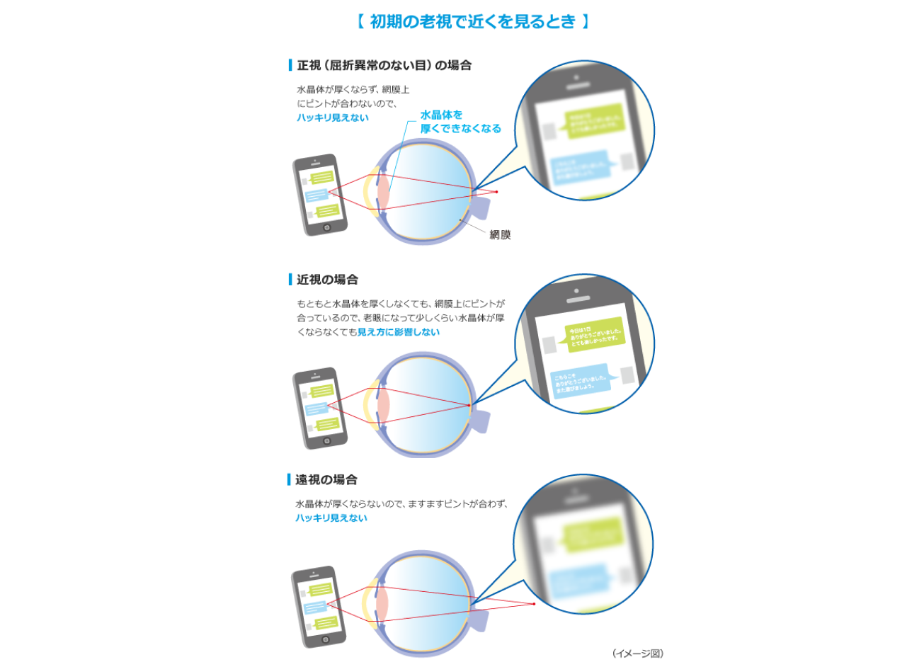 初期の老眼で近くを見るとき　イメージ図