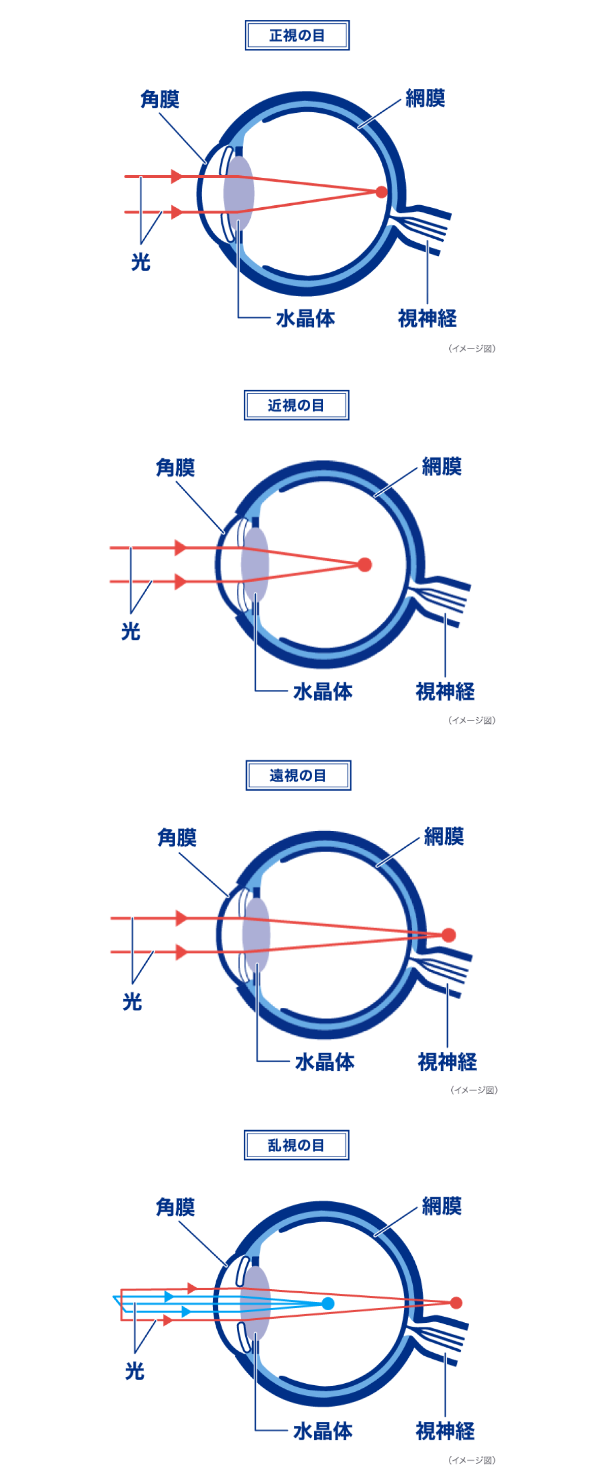 正視の目　近視の目　遠視の目　乱視の目　イメージ図
