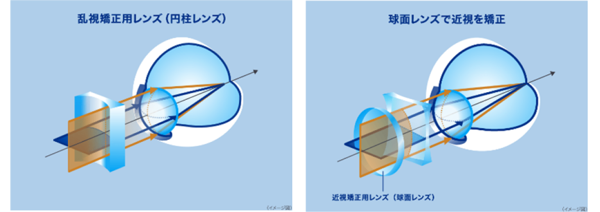 乱視矯正用レンズ（円柱レンズ） 球面レンズで禁止を矯正