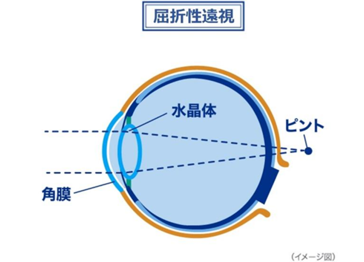 屈折性遠視