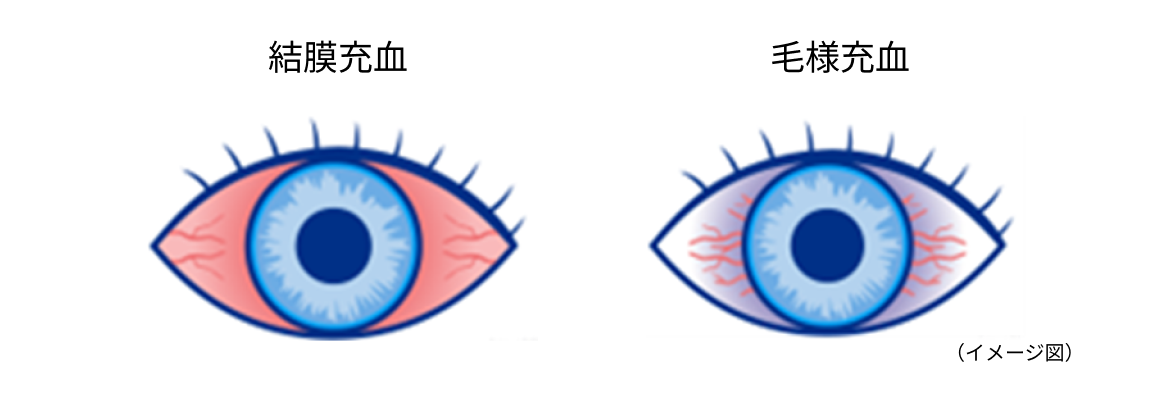 結膜充血 イメージ図