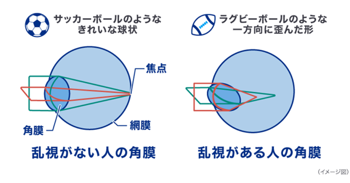 乱視がない人の角膜と乱視がある人の角膜のイメージ図