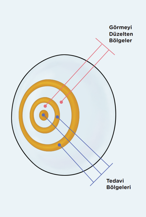 RingBoost™ Teknolojisi hakkında temsili görsel RingBoost™ Teknolojisi hakkında temsili görsel