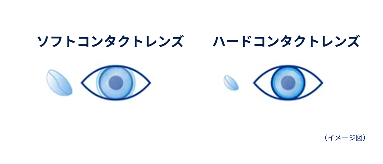 (イメージ図)ソフトコンタクトレンズとハードコンタクトレンズ (イメージ図)ソフトコンタクトレンズとハードコンタクトレンズ