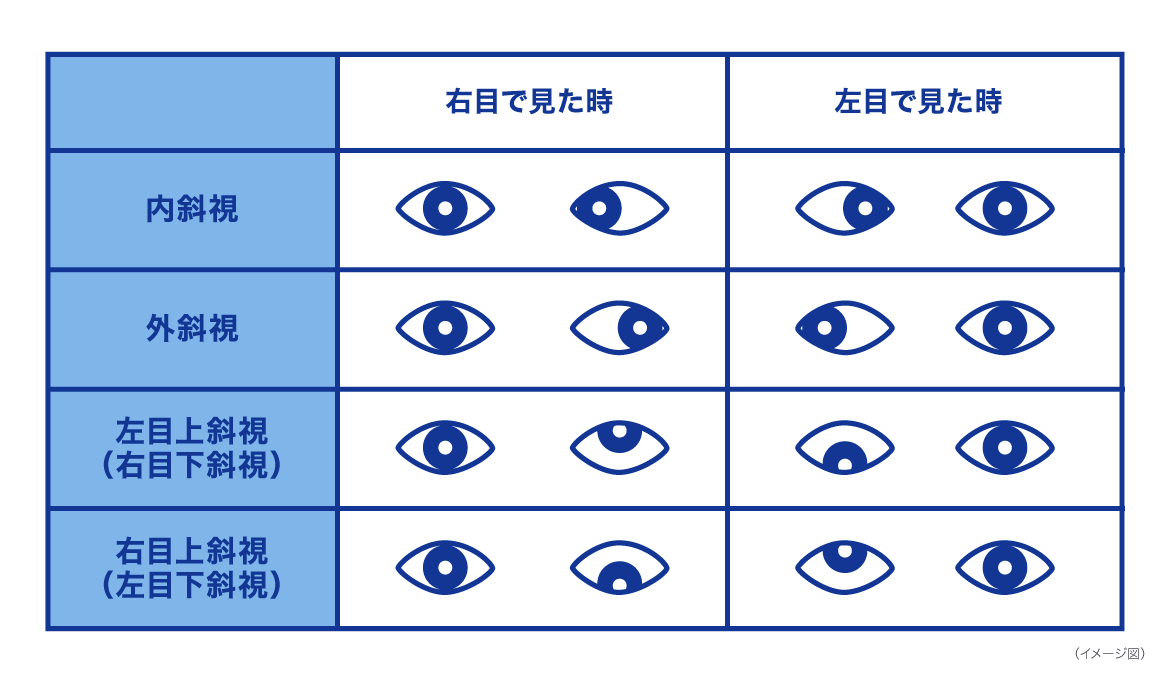 斜視の種類 イメージ図