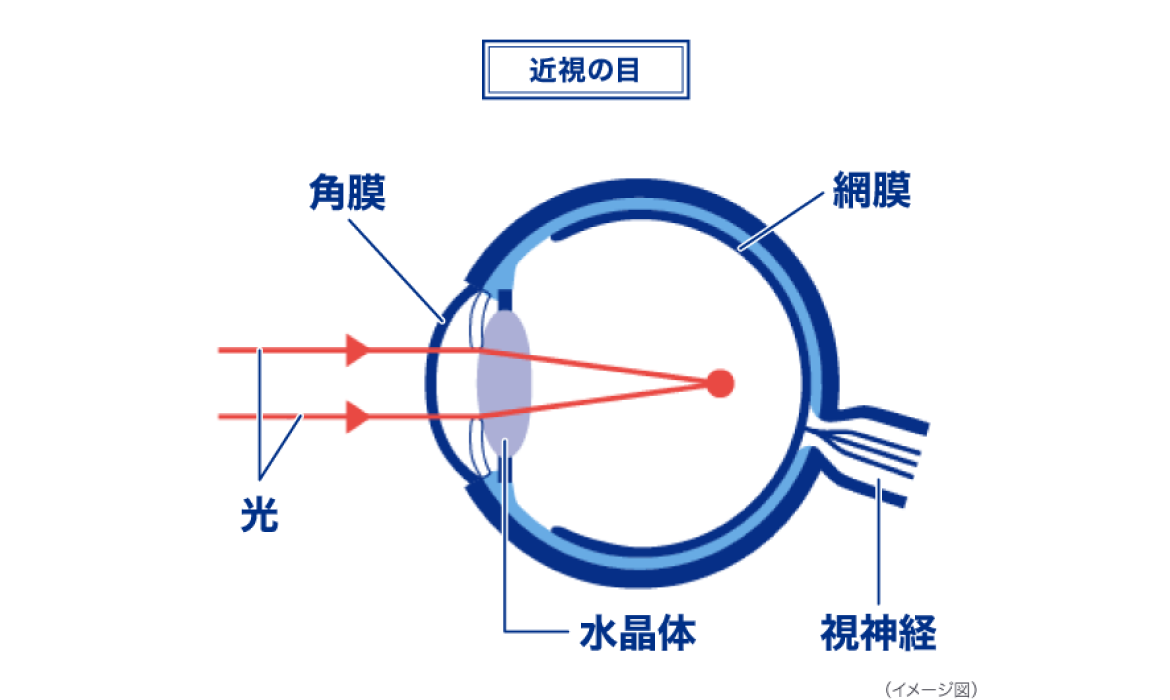 近視の目