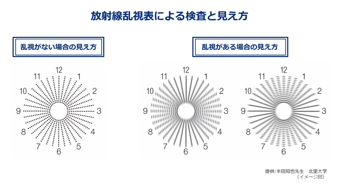 放射線乱視表による検査と見え方